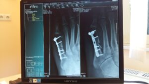 When Are Florida Car Accident Bone Injuries Considered Severe?